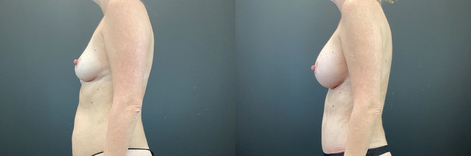 Mommy Makeover Before & After