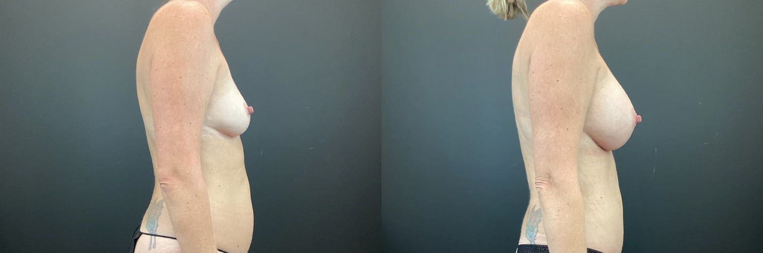 Mommy Makeover Before & After