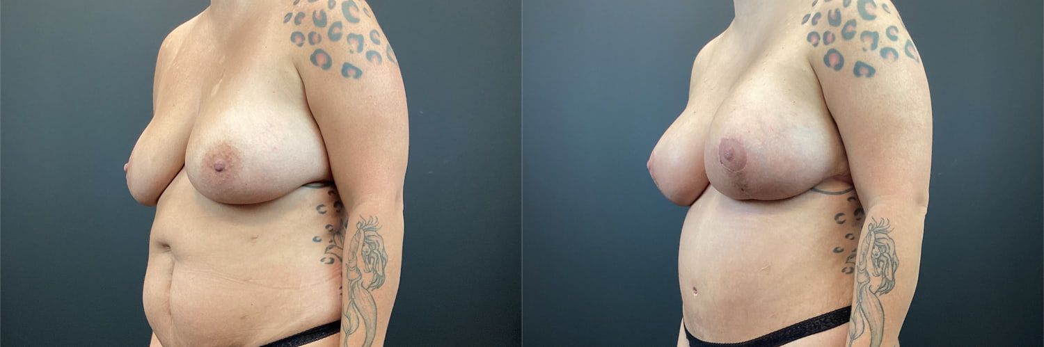 Mommy Makeover Before & After