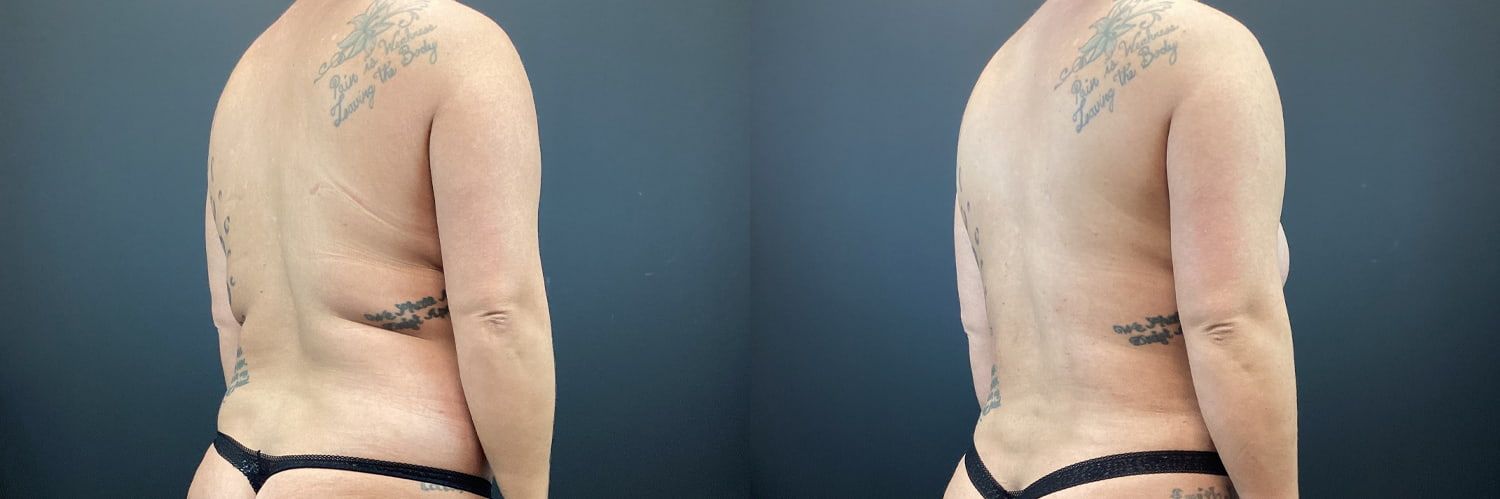 Mommy Makeover Before & After