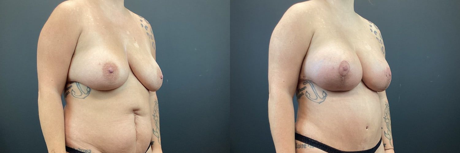 Mommy Makeover Before & After