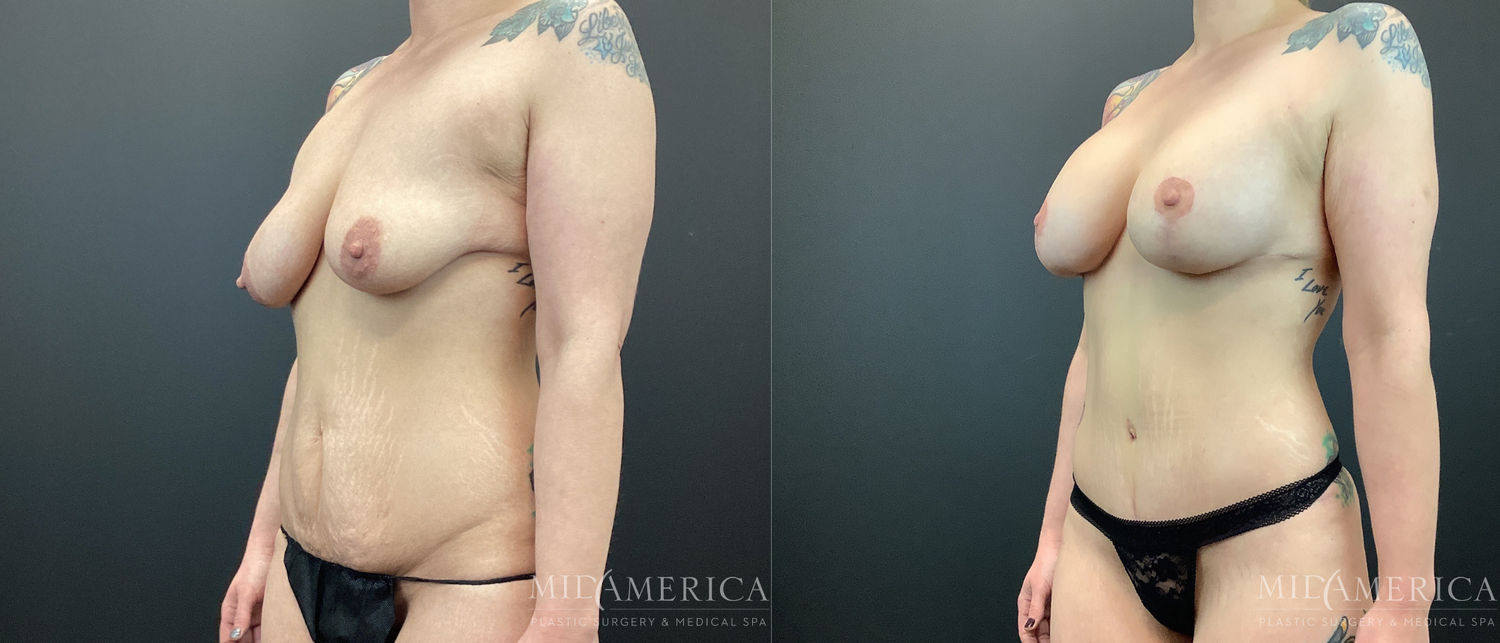 Mommy Makeover Before & After