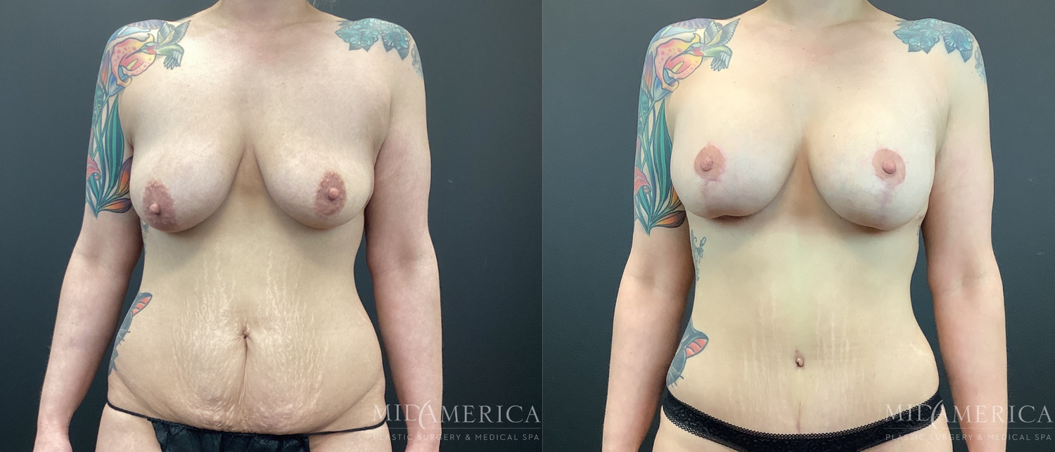 Mommy Makeover Before & After