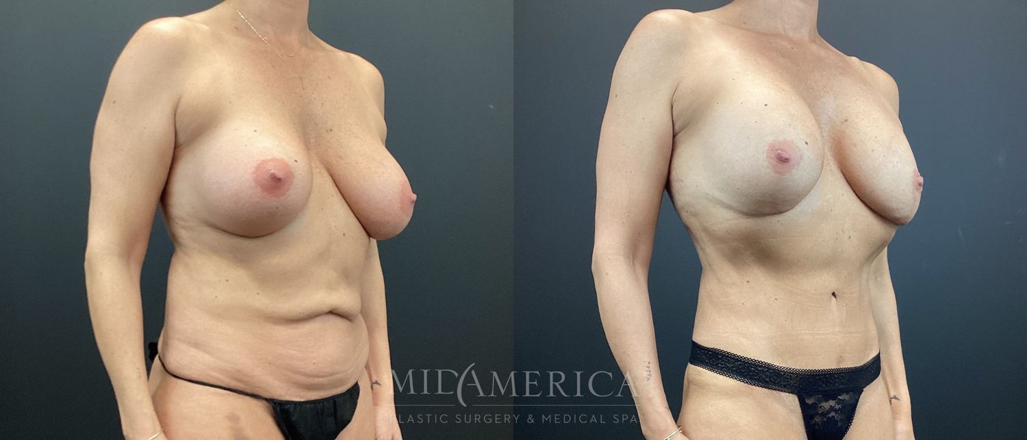 Mommy Makeover Before & After