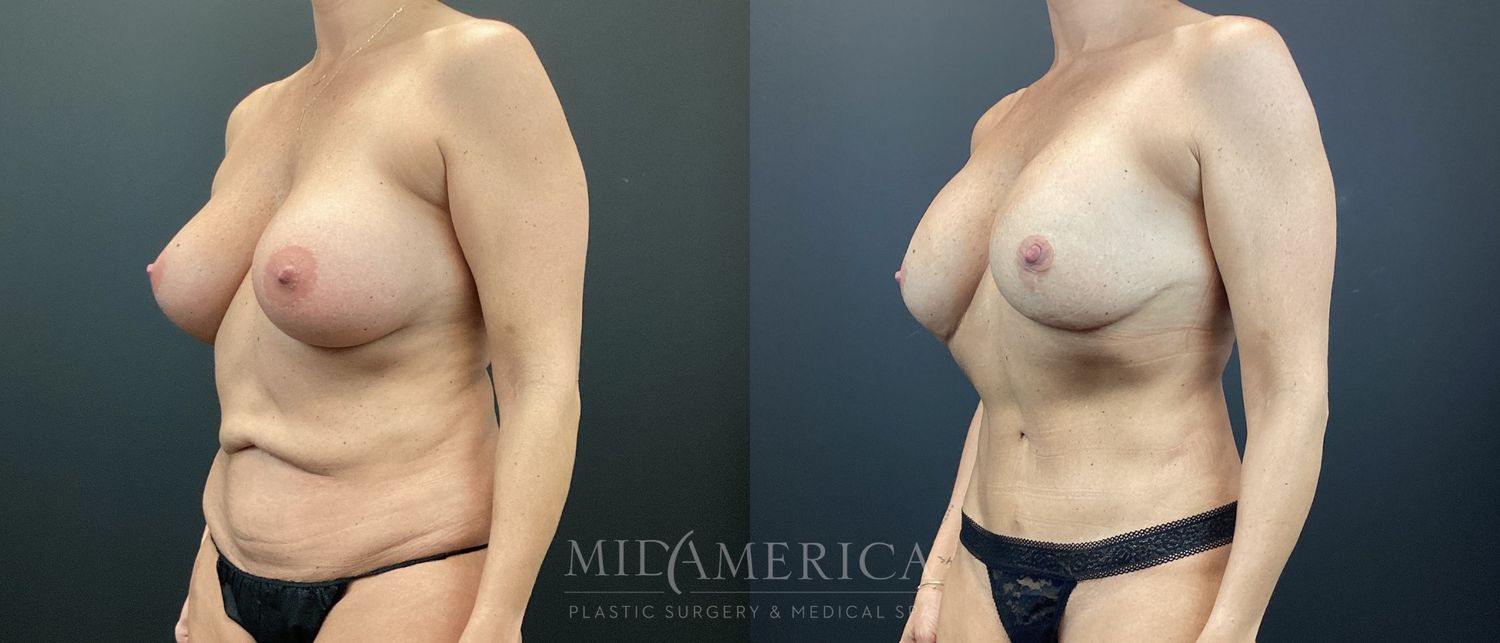 Mommy Makeover Before & After