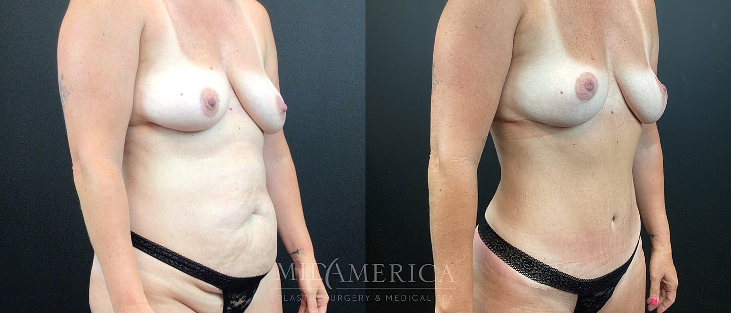 Mommy Makeover Before & After