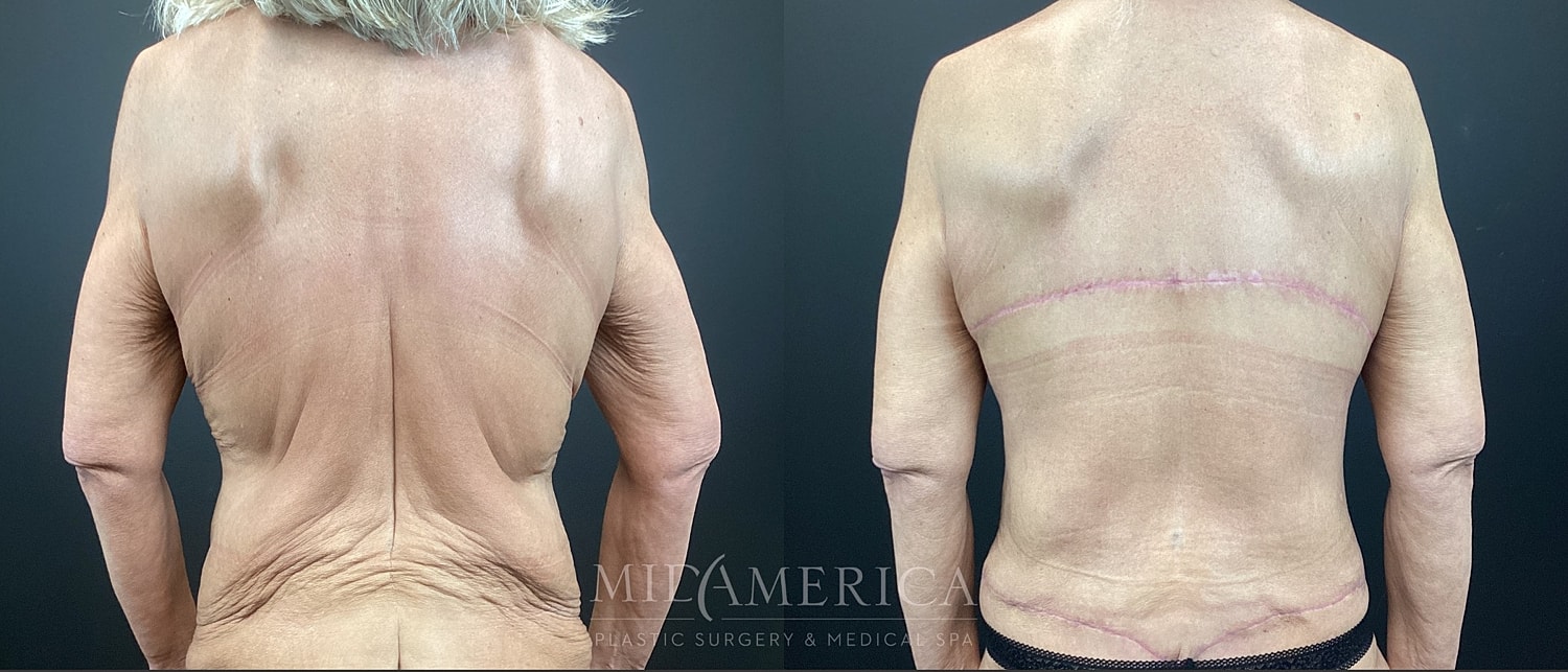 Mommy Makeover Before & After