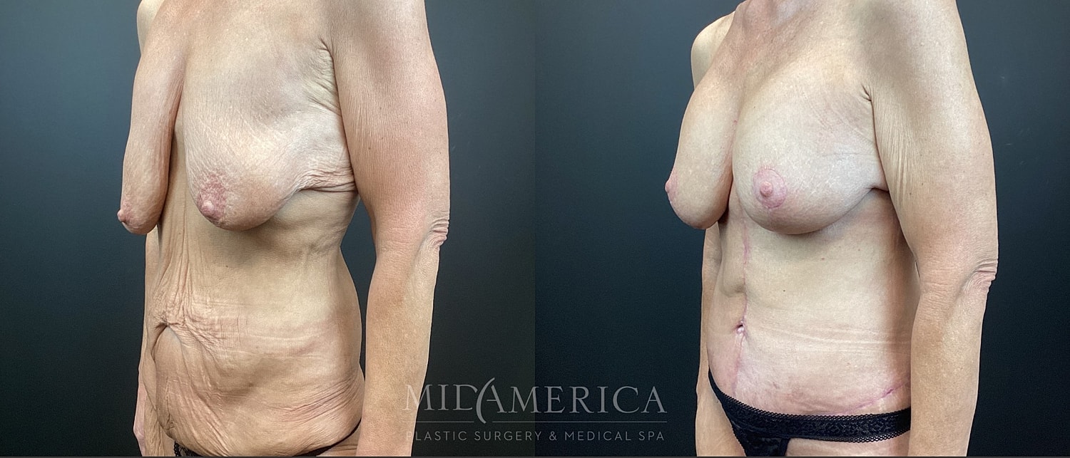 Mommy Makeover Before & After