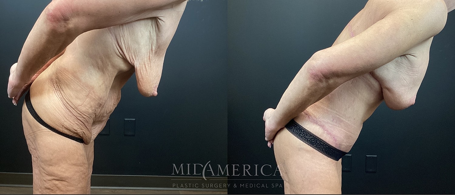 Mommy Makeover Before & After