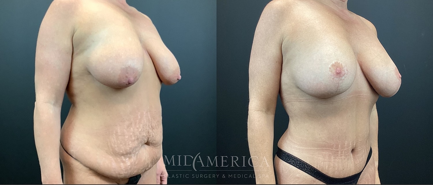 Mommy Makeover Before & After