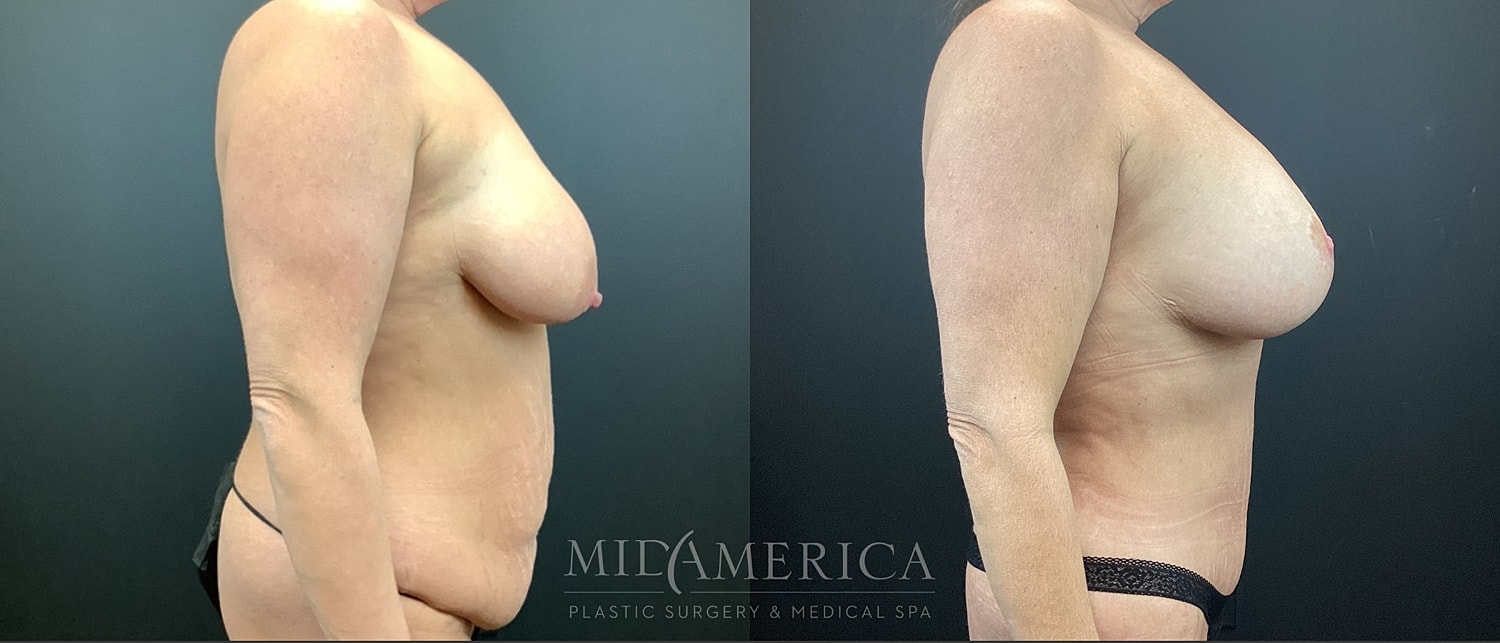 Mommy Makeover Before & After