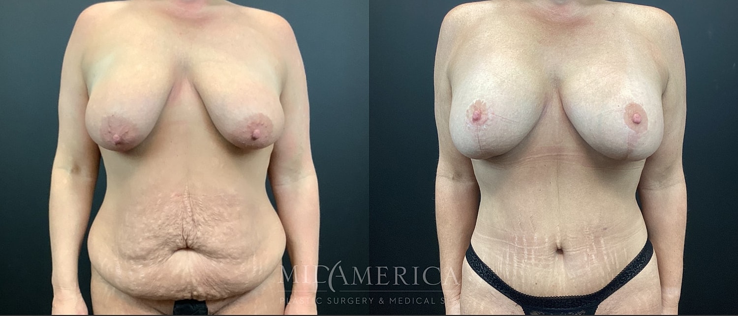 Mommy Makeover Before & After