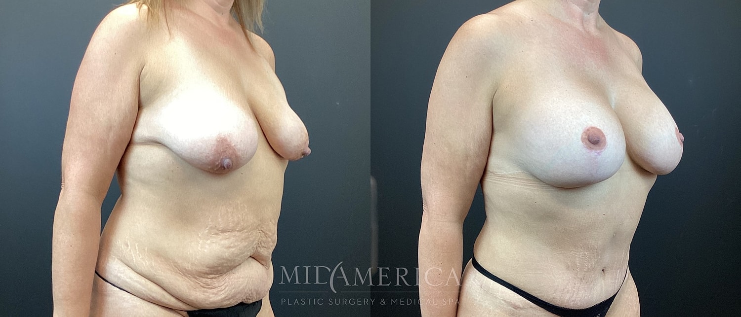 Mommy Makeover Before & After