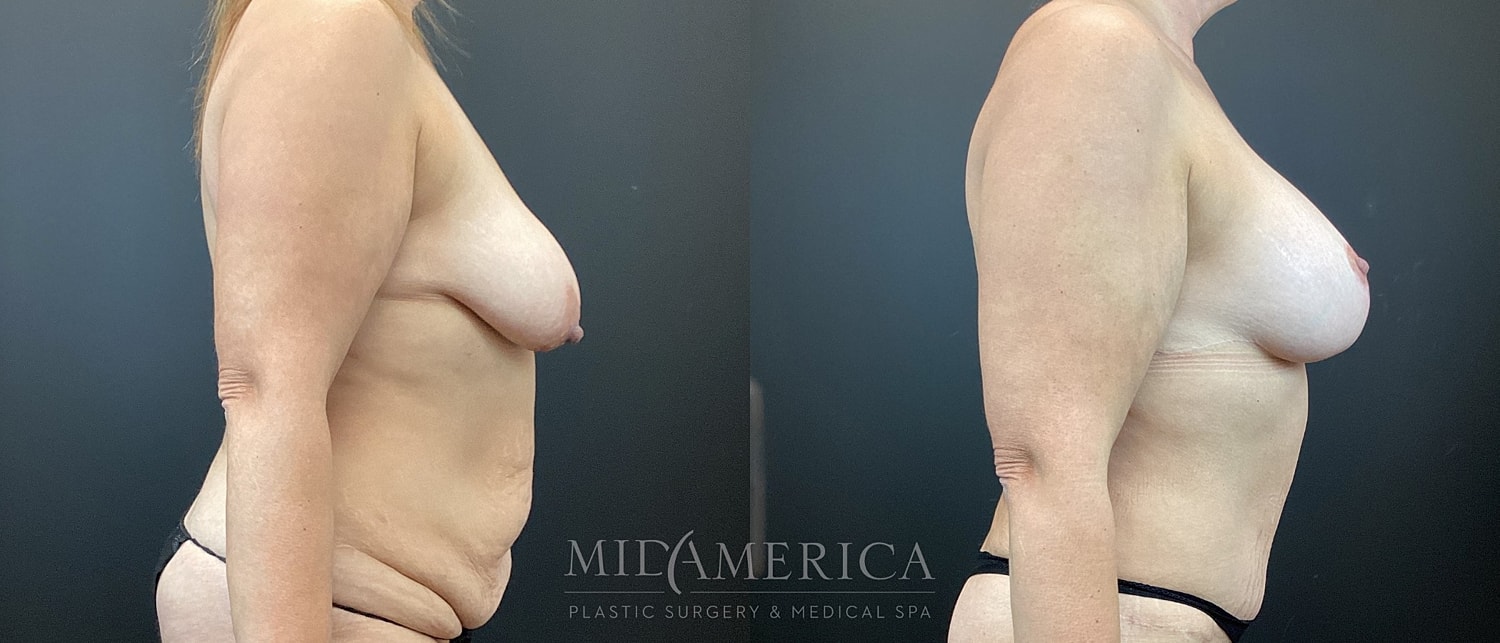 Mommy Makeover Before & After