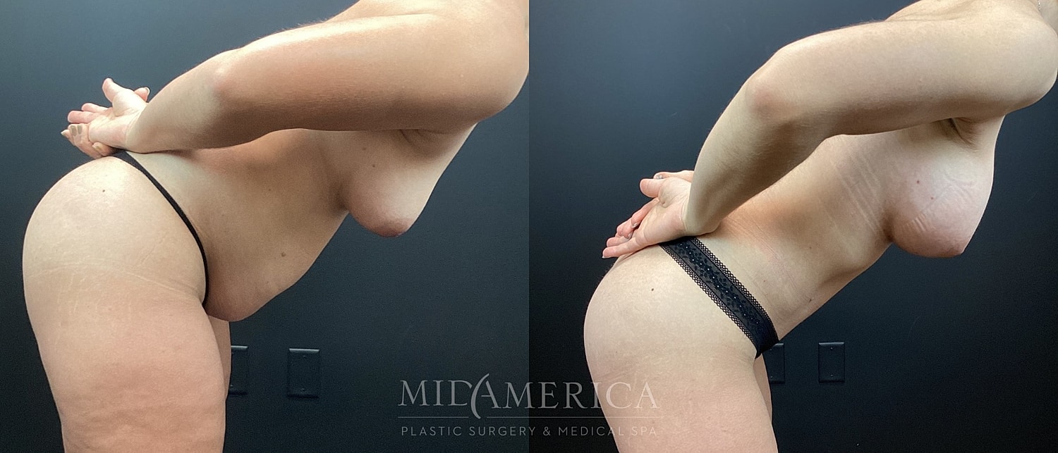 Mommy Makeover Before & After