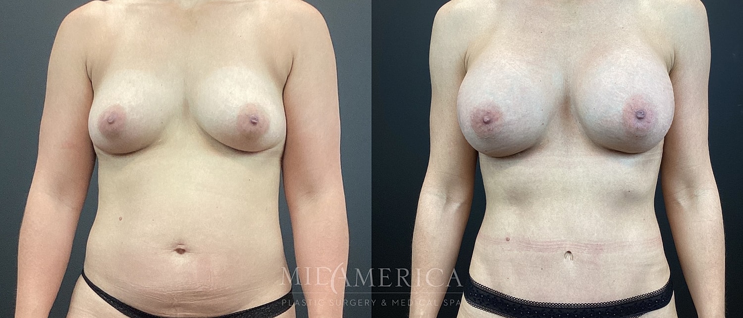 Mommy Makeover Before & After