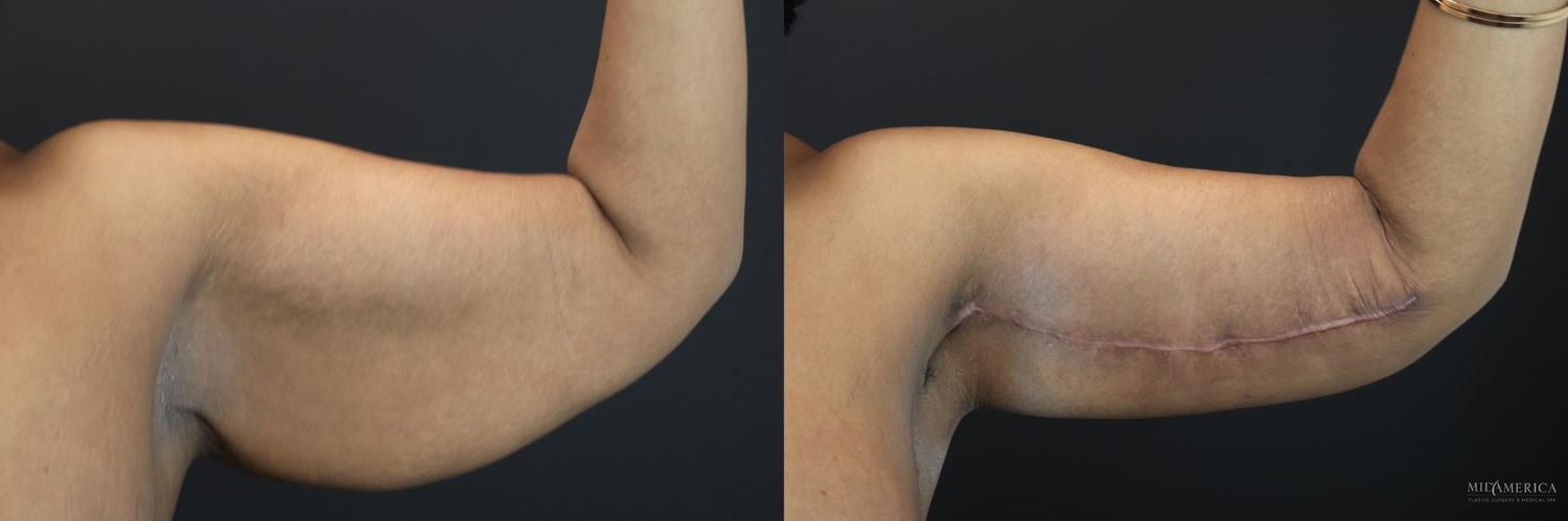 Brachioplasty Before & After