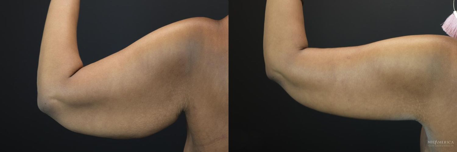 Brachioplasty Before & After