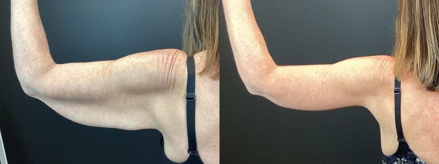 Brachioplasty Before & After