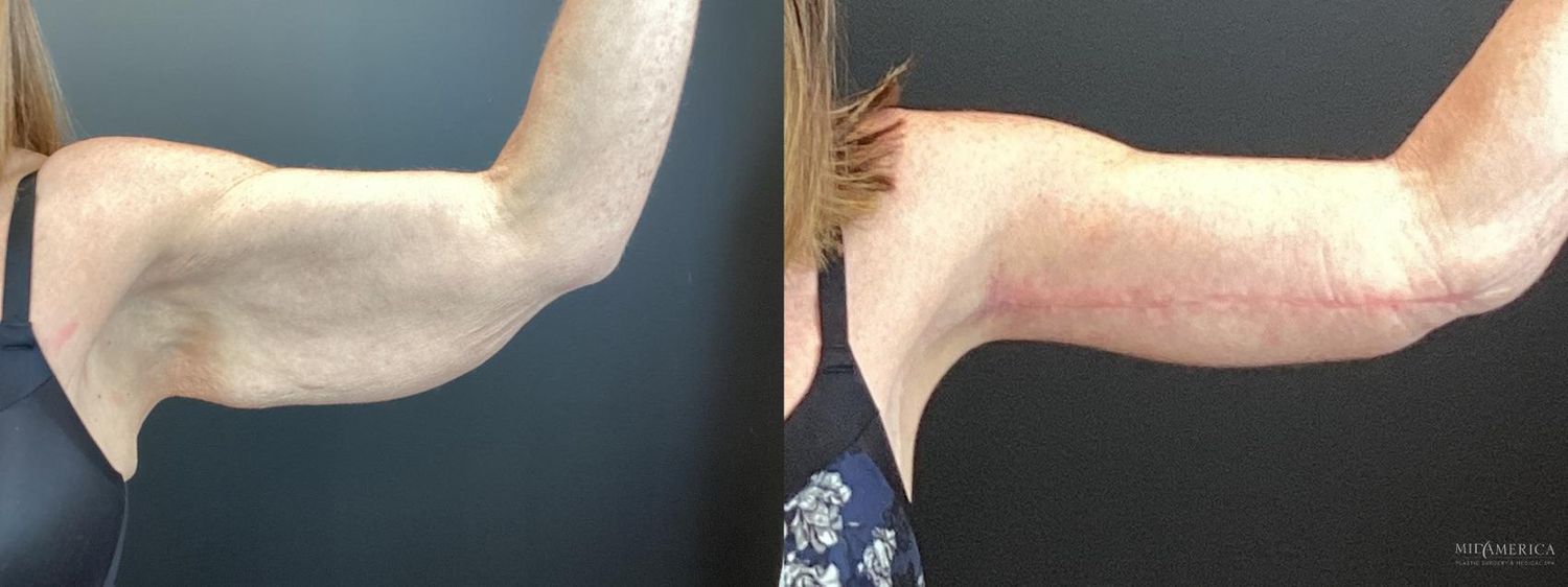 Brachioplasty Before & After