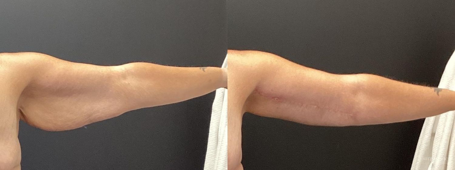 Brachioplasty Before & After