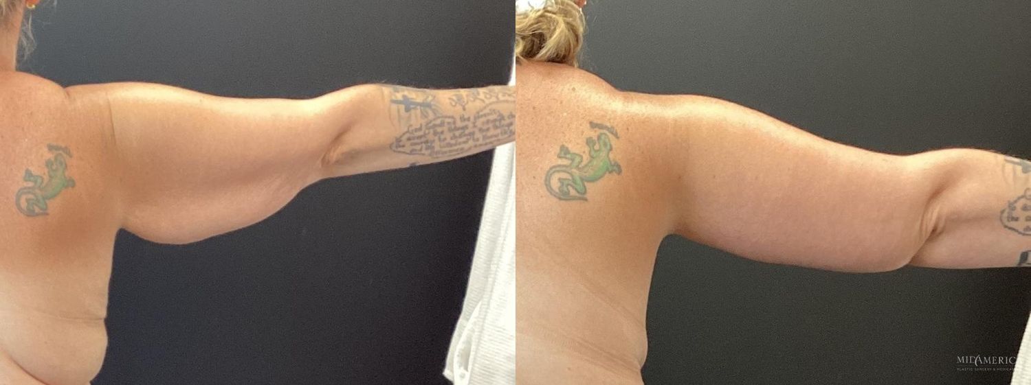 Brachioplasty Before & After