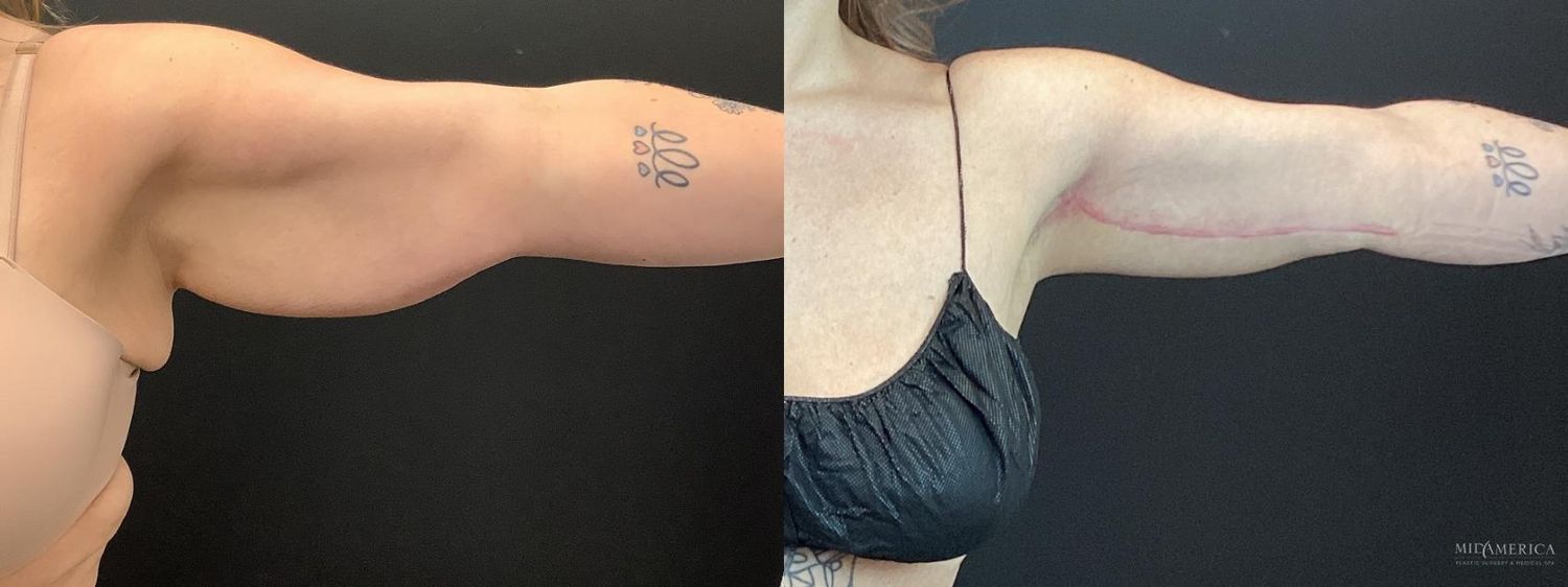 Brachioplasty Before & After
