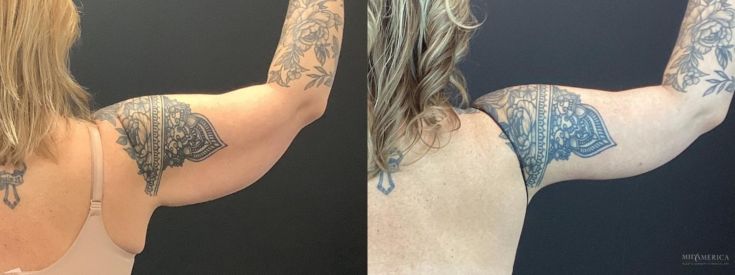 Brachioplasty Before & After