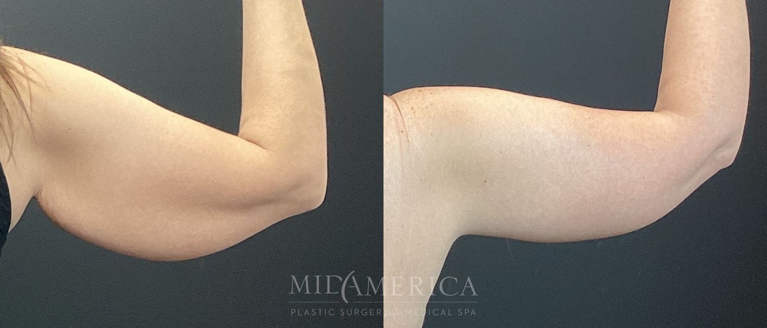Brachioplasty Before & After