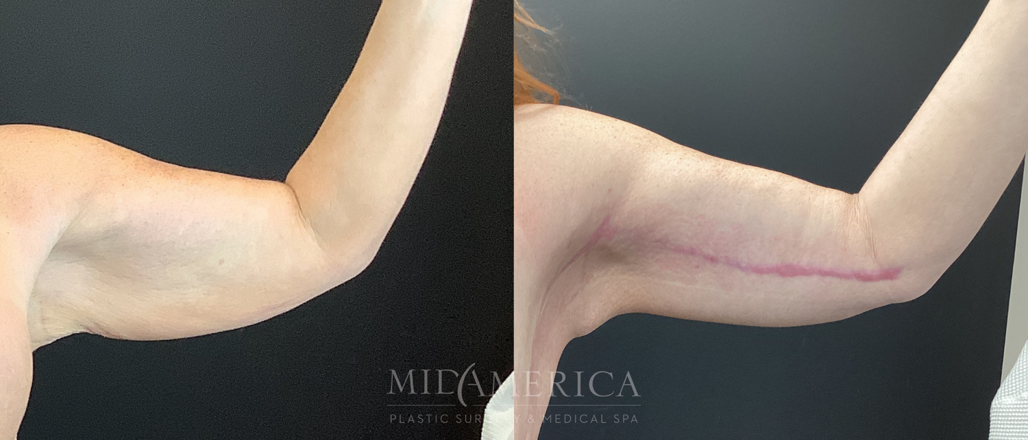 Brachioplasty Before & After
