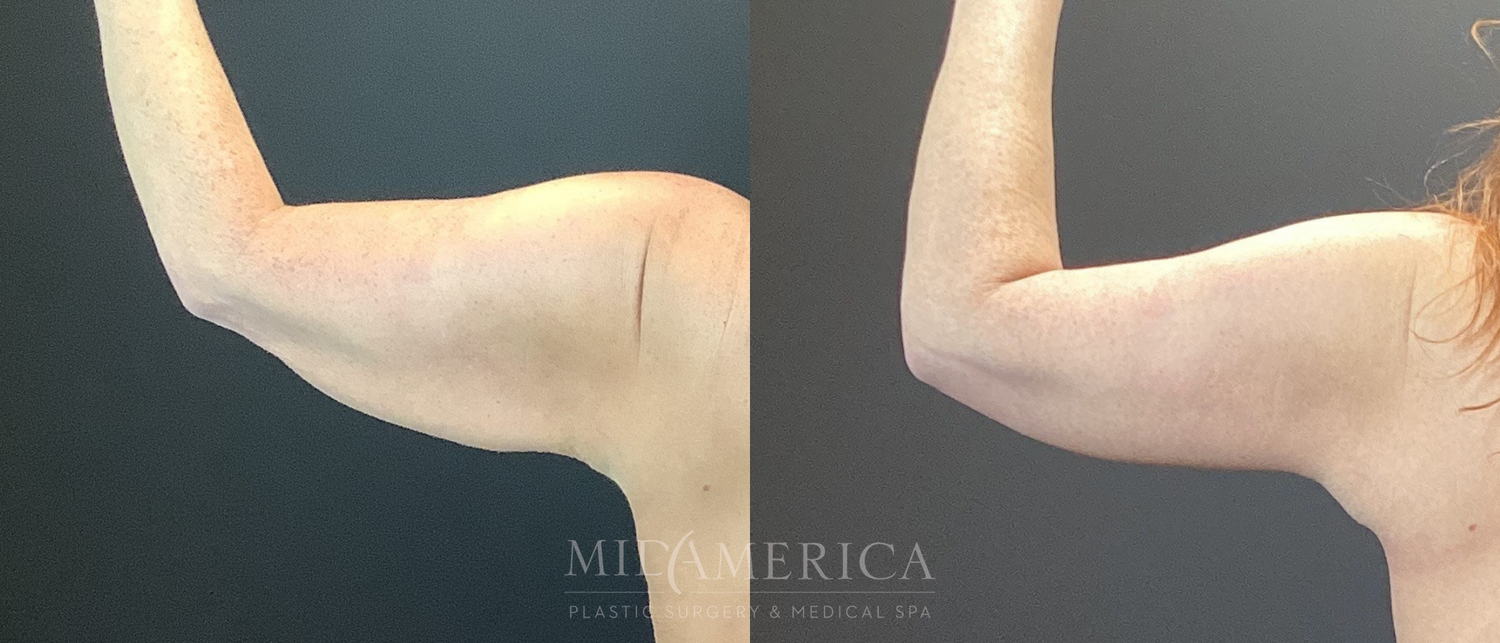 Brachioplasty Before & After