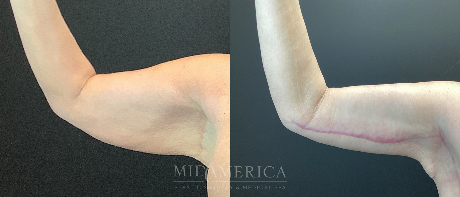 Brachioplasty Before & After