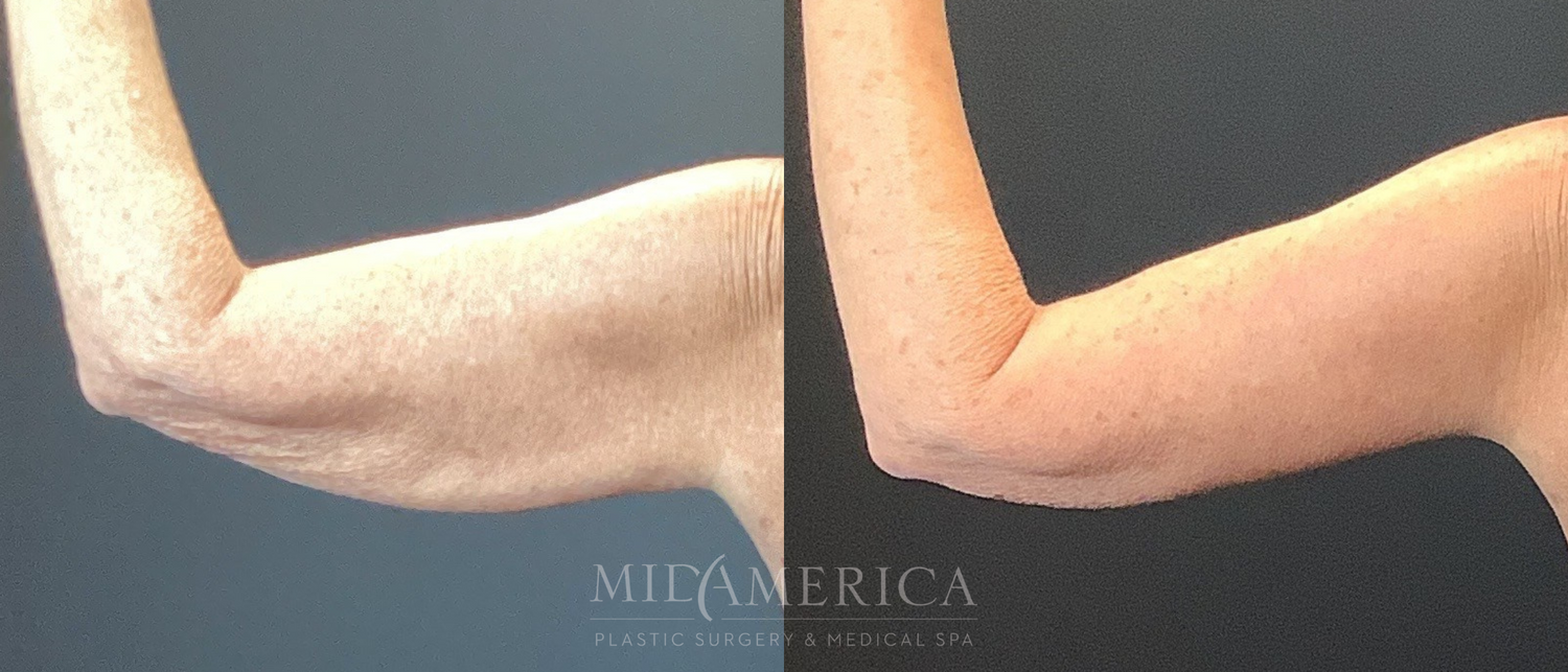 Brachioplasty Before & After