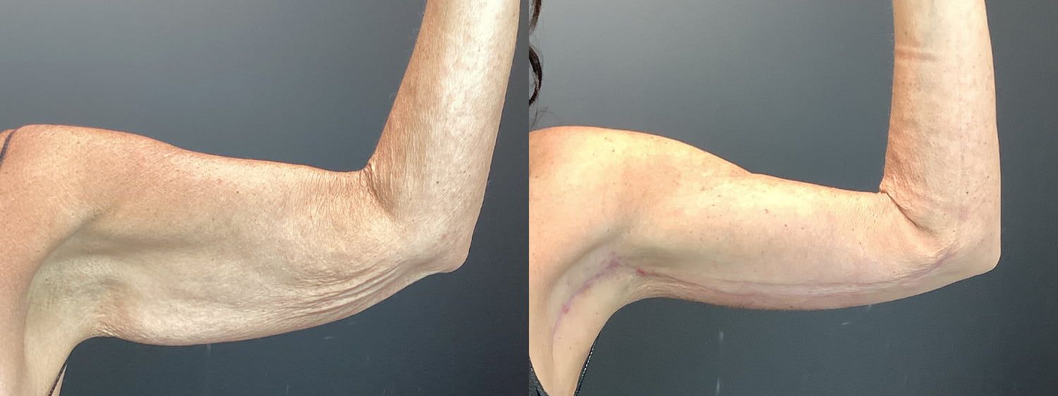 Brachioplasty Before & After