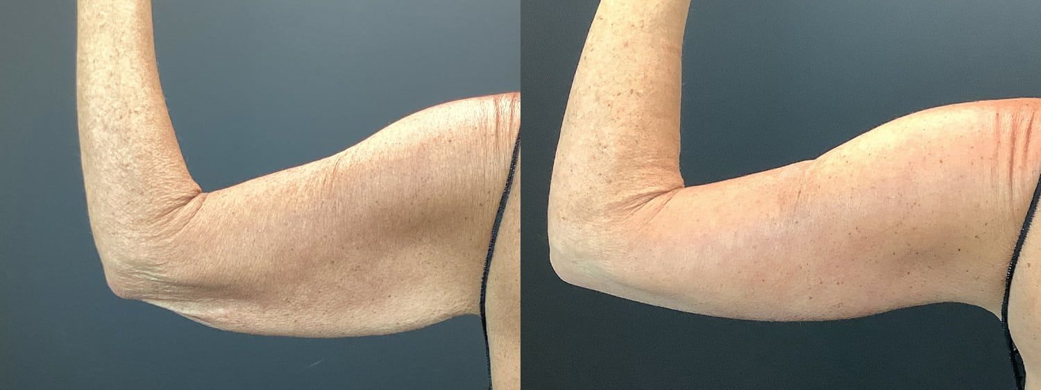 Brachioplasty Before & After