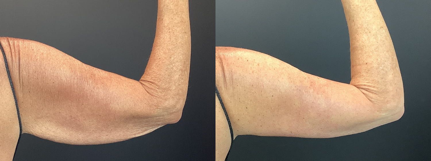 Brachioplasty Before & After