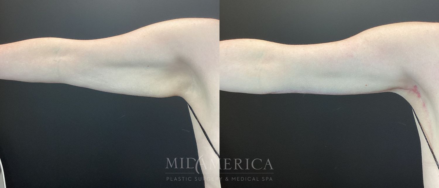 Brachioplasty Before & After