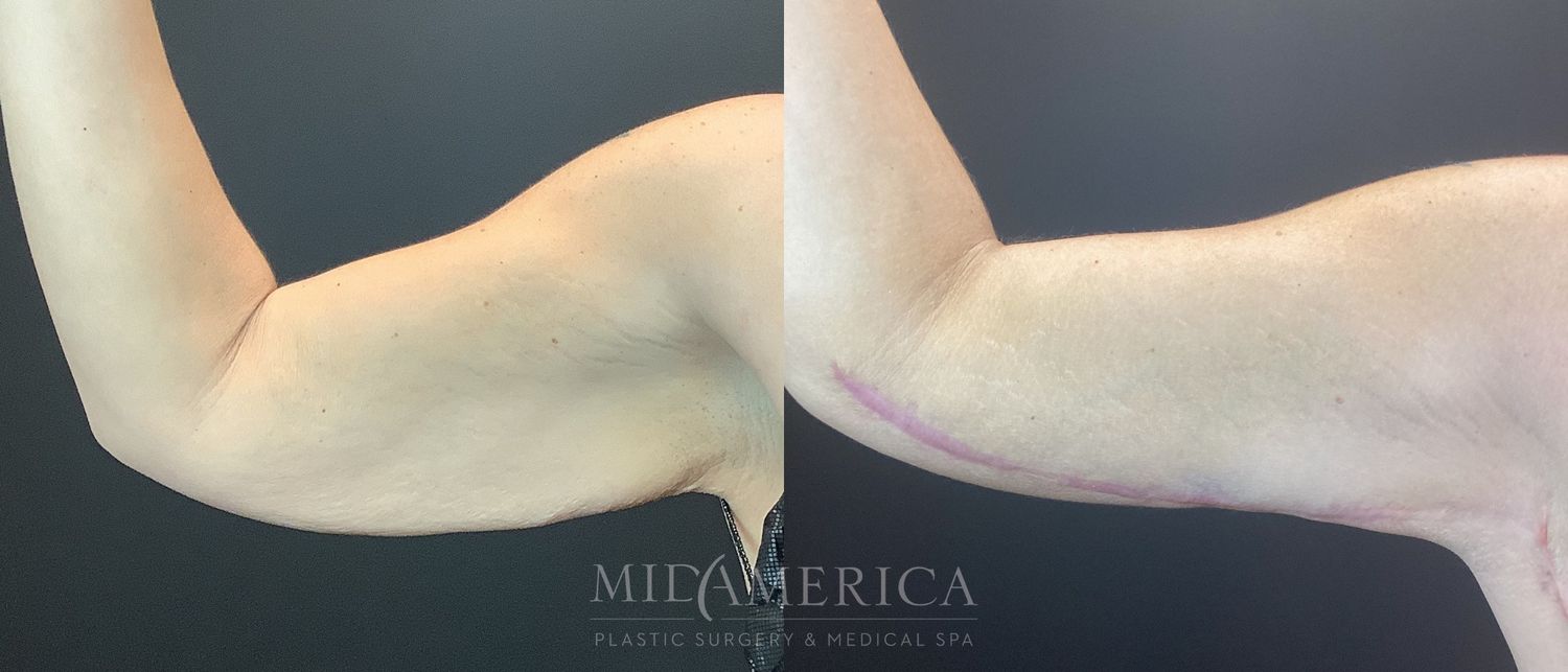 Brachioplasty Before & After