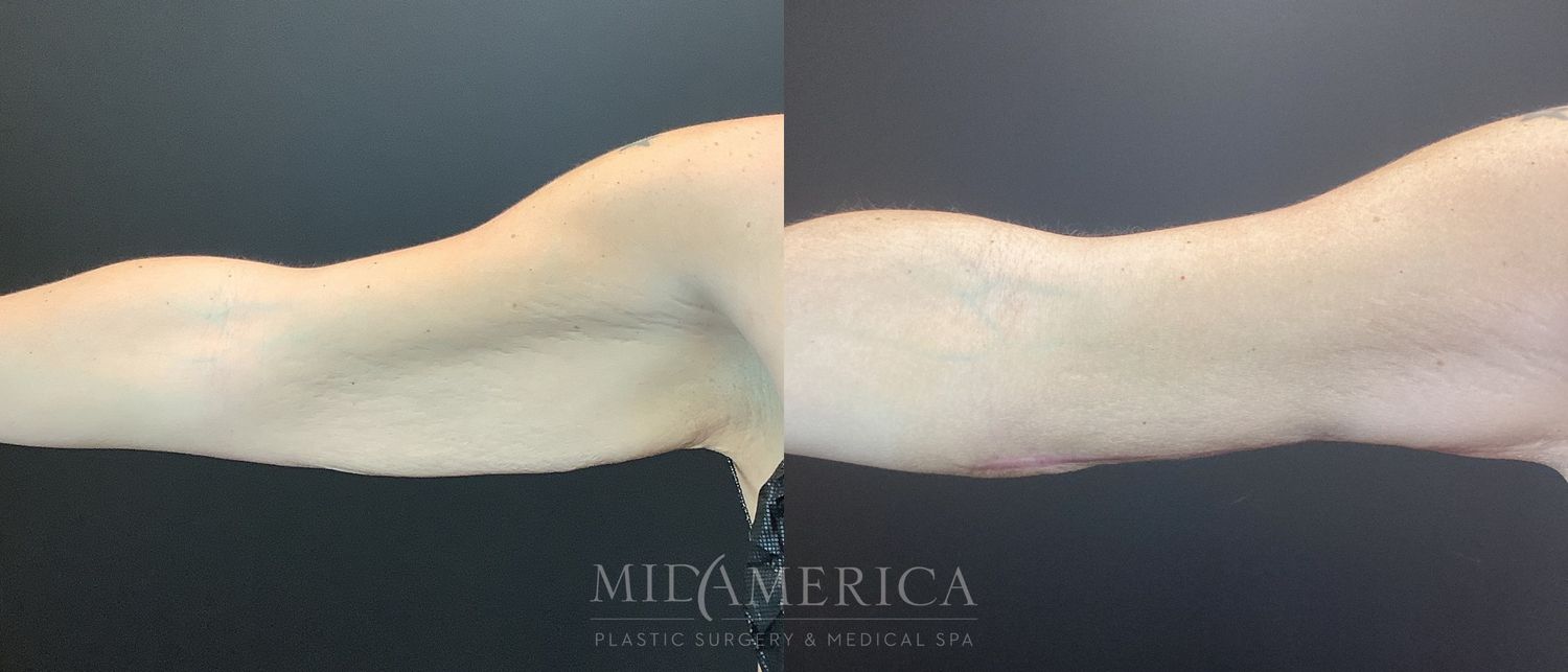 Brachioplasty Before & After
