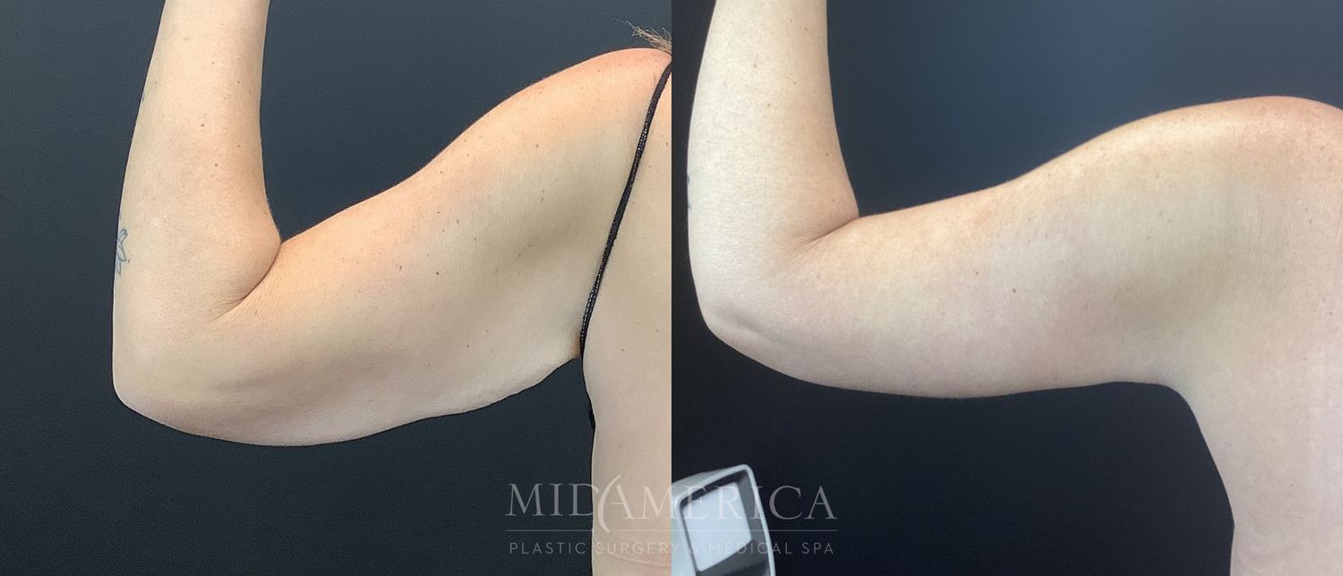 Brachioplasty Before & After