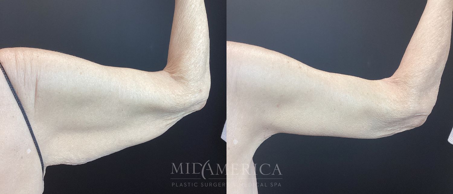 Brachioplasty Before & After