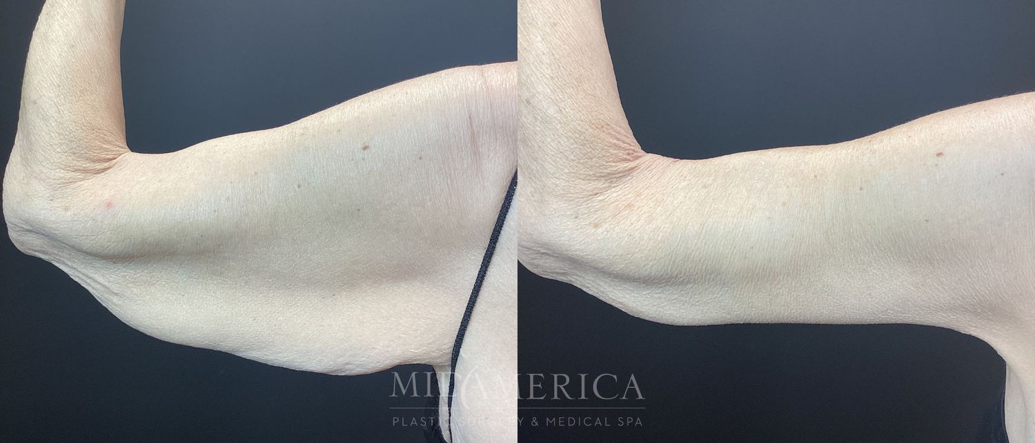Brachioplasty Before & After
