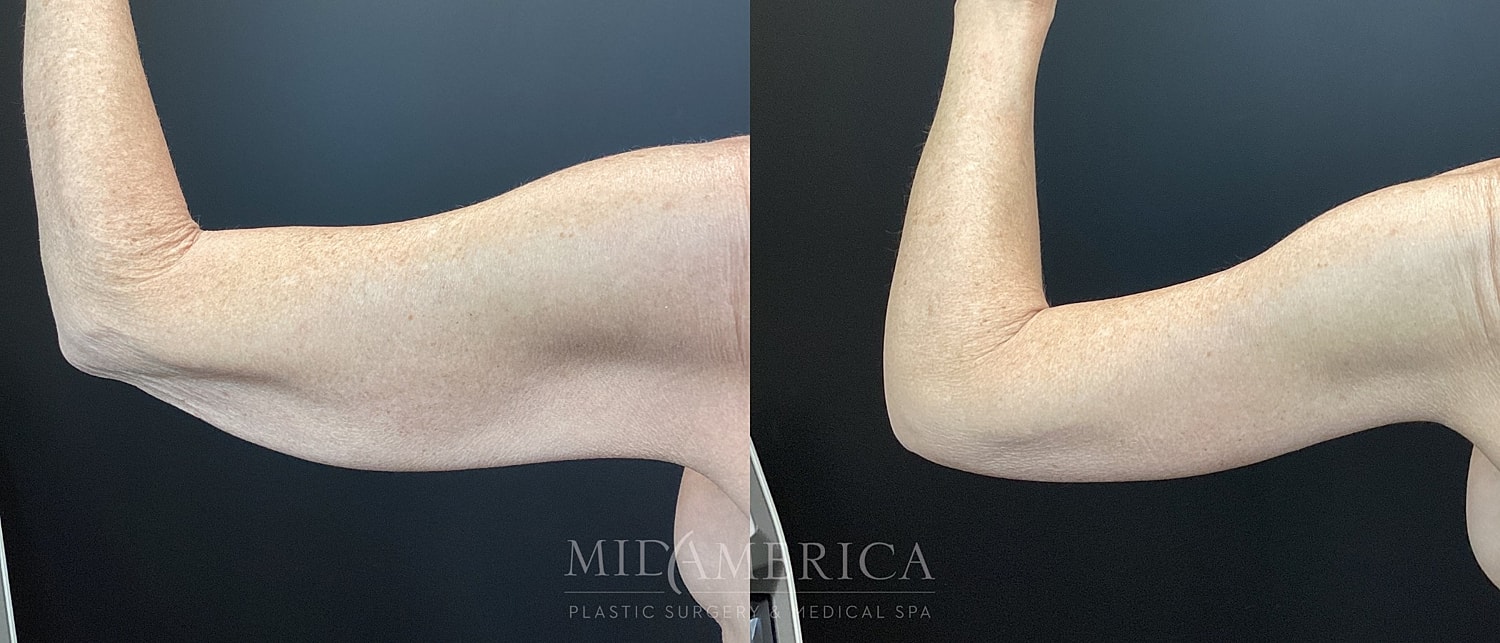 Brachioplasty Before & After