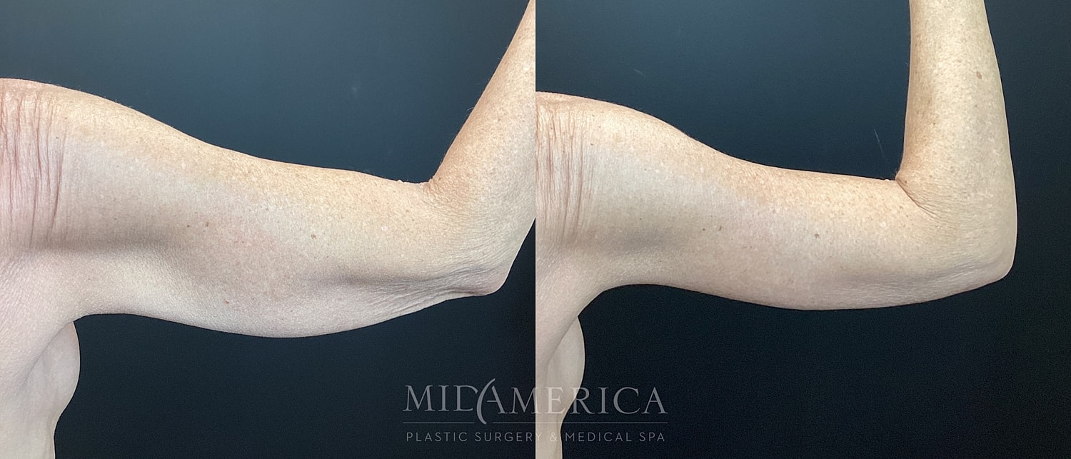 Brachioplasty Before & After