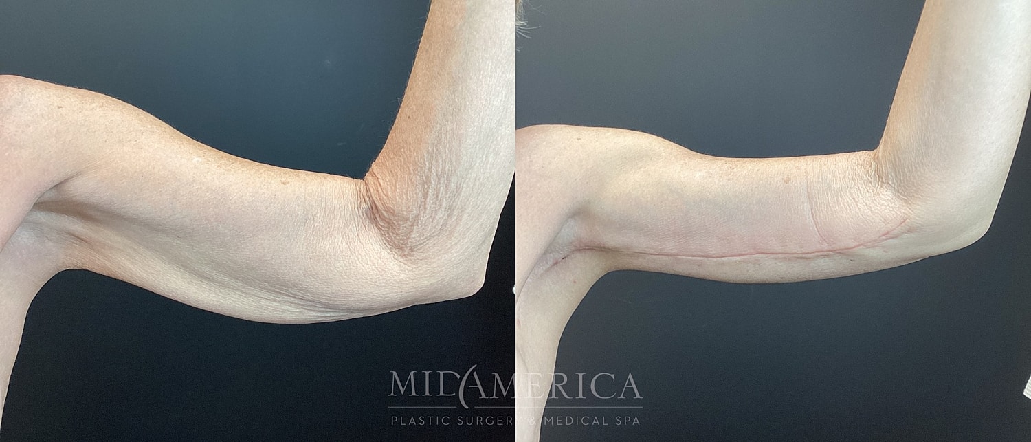 Brachioplasty Before & After
