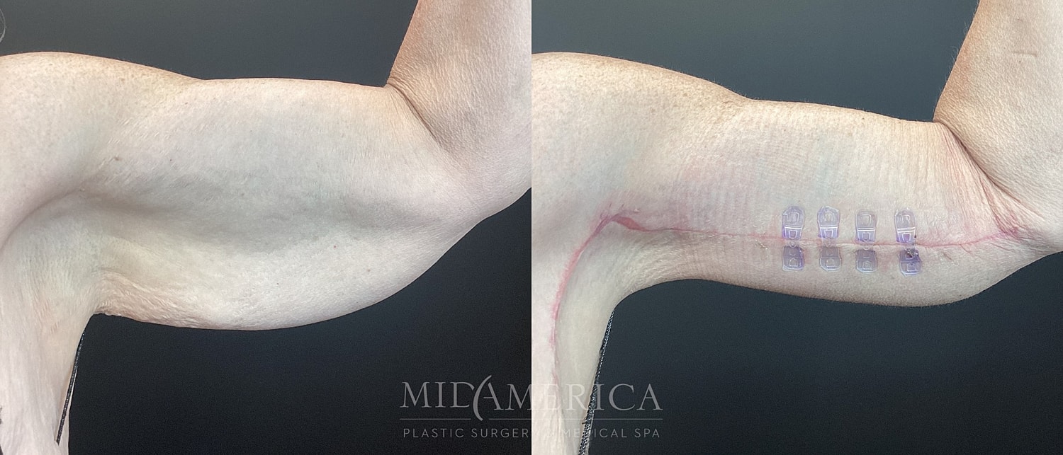 Brachioplasty Before & After