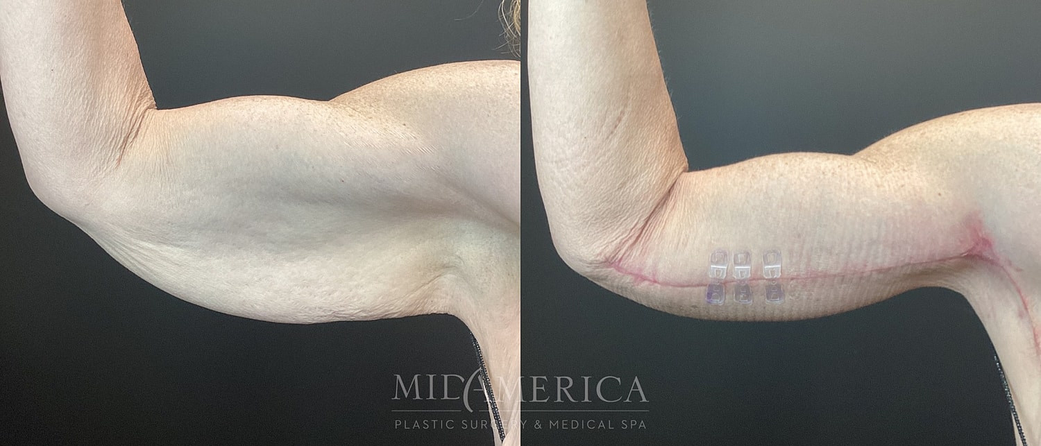 Brachioplasty Before & After
