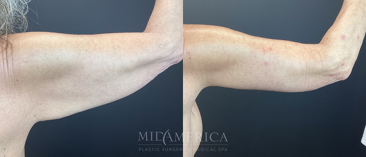 Brachioplasty Before & After