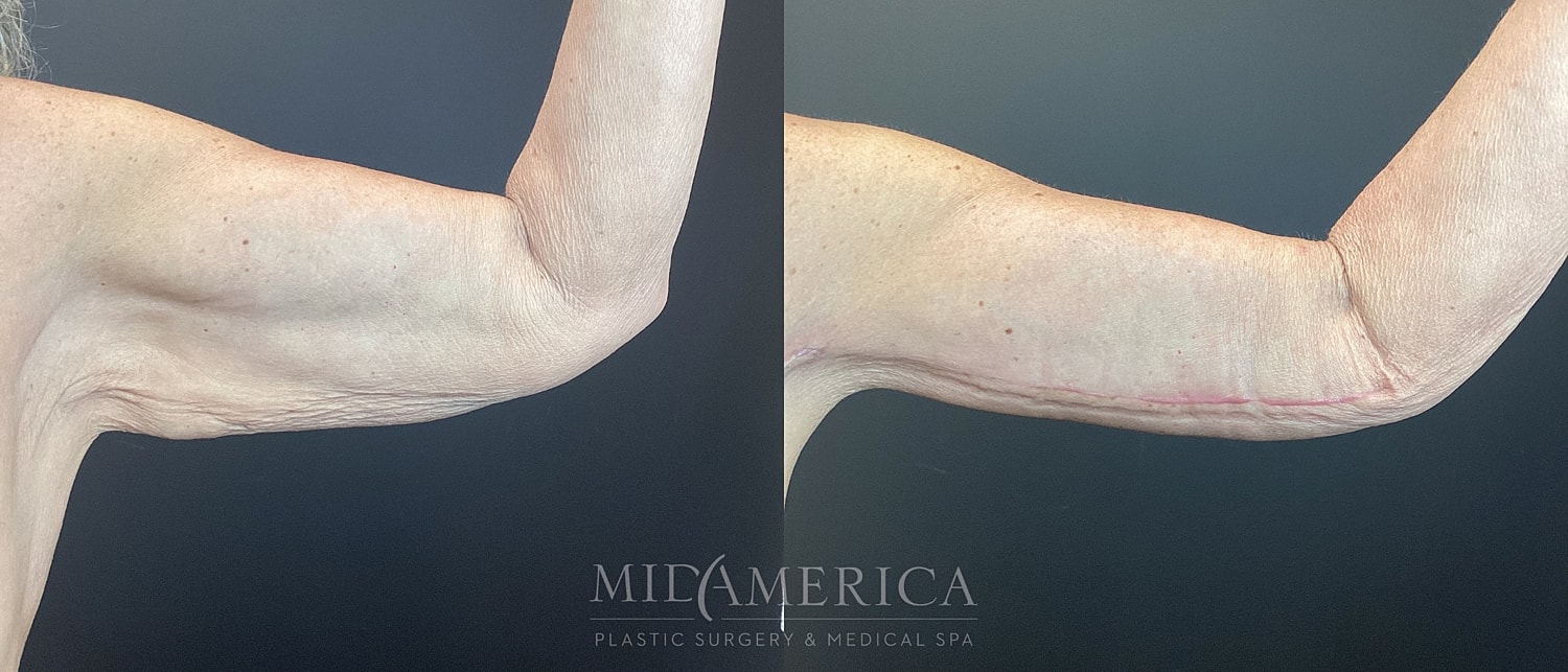 Brachioplasty Before & After
