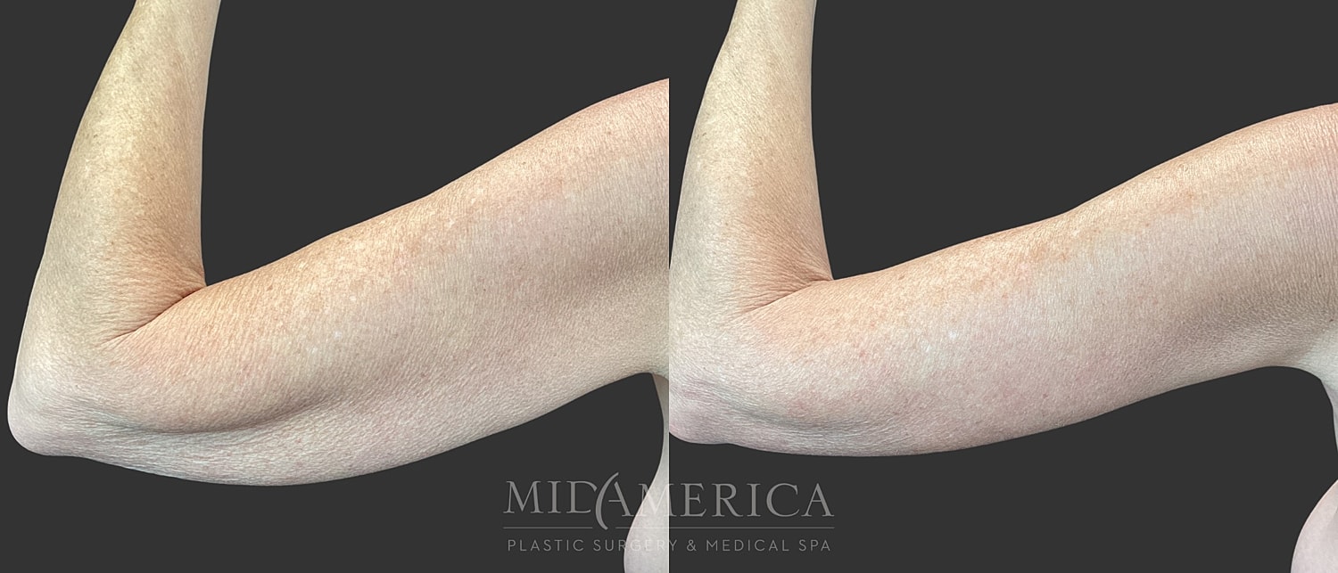 Brachioplasty Before & After